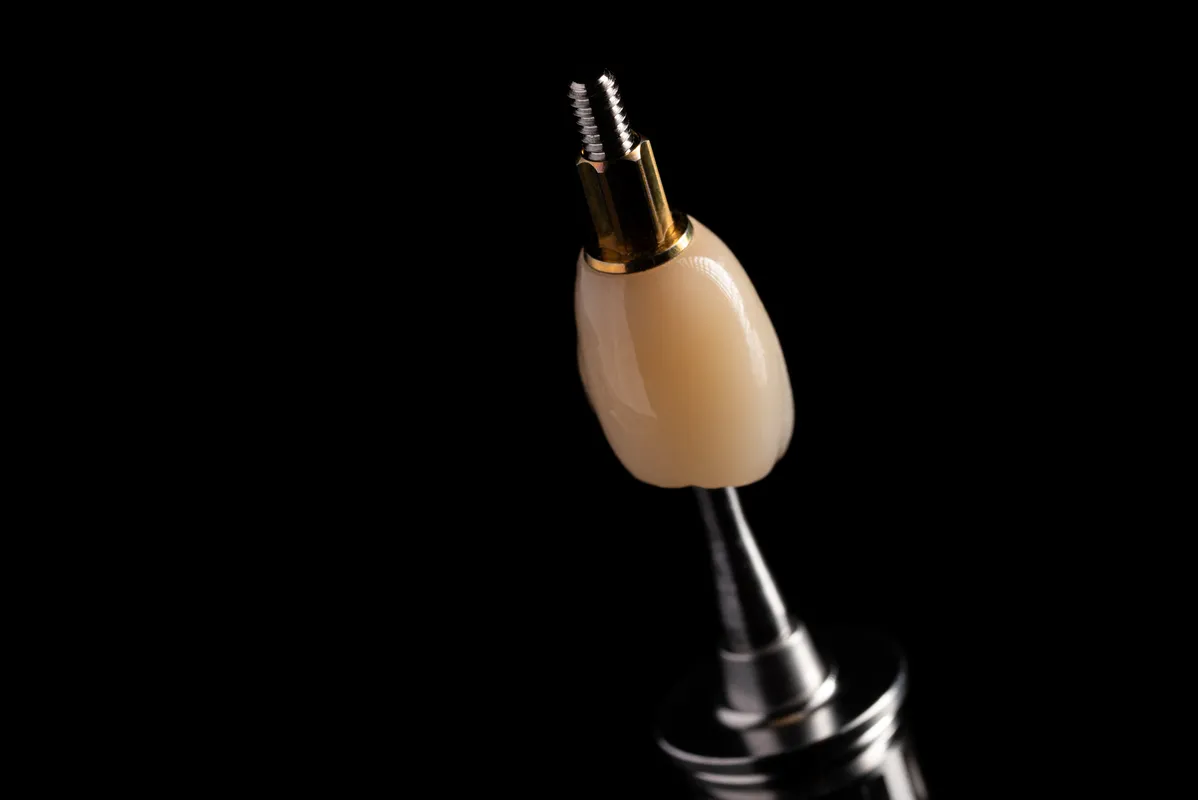 Lucrări Fixe pe Implant - dentalbit dental bit tg mureș laborator tehnică dentară laborator tehnica dentara tg mures mures fogtechnikus marosvasarhely fogtechnia CAD/CAM exocad digital Laborator Tehnică Dentară Proiectare Digitală Dentară Lucrări Fixe Lucrări Fixe Pe Implant Lucrări Mobile Lucrări Mobilizabile tehnică dentară digitală