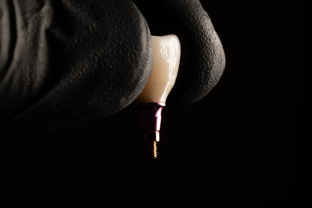 Lucrări Fixe pe Implant - dentalbit dental bit tg mureș laborator tehnică dentară laborator tehnica dentara tg mures mures fogtechnikus marosvasarhely fogtechnia CAD/CAM exocad digital Laborator Tehnică Dentară Proiectare Digitală Dentară Lucrări Fixe Lucrări Fixe Pe Implant Lucrări Mobile Lucrări Mobilizabile tehnică dentară digitală