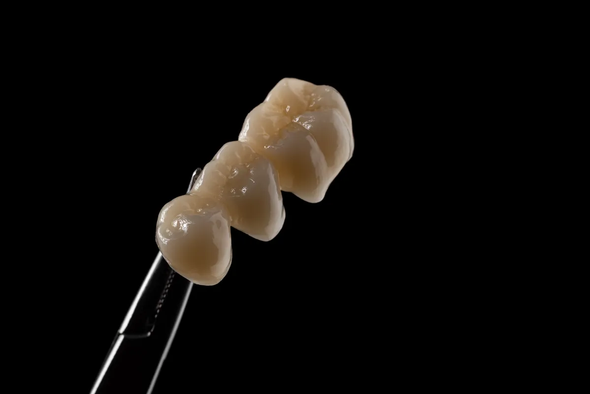 Lucrări Fixe - dentalbit dental bit tg mureș laborator tehnică dentară laborator tehnica dentara tg mures mures fogtechnikus marosvasarhely fogtechnia CAD/CAM exocad digital Laborator Tehnică Dentară Proiectare Digitală Dentară Lucrări Fixe Lucrări Fixe Pe Implant Lucrări Mobile Lucrări Mobilizabile tehnică dentară digitală