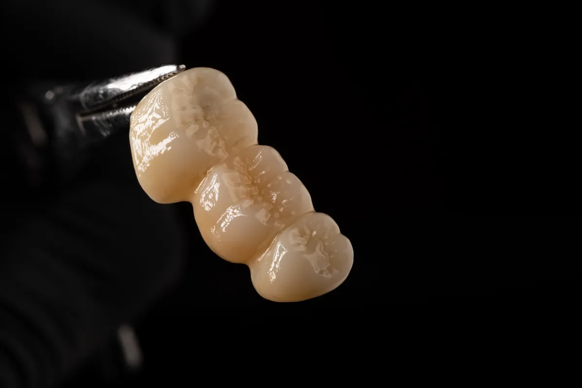 Lucrări Fixe - dentalbit dental bit tg mureș laborator tehnică dentară laborator tehnica dentara tg mures mures fogtechnikus marosvasarhely fogtechnia CAD/CAM exocad digital Laborator Tehnică Dentară Proiectare Digitală Dentară Lucrări Fixe Lucrări Fixe Pe Implant Lucrări Mobile Lucrări Mobilizabile tehnică dentară digitală