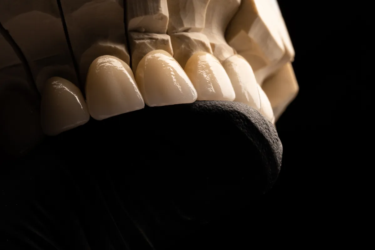 Lucrări Fixe - dentalbit dental bit tg mureș laborator tehnică dentară laborator tehnica dentara tg mures mures fogtechnikus marosvasarhely fogtechnia CAD/CAM exocad digital Laborator Tehnică Dentară Proiectare Digitală Dentară Lucrări Fixe Lucrări Fixe Pe Implant Lucrări Mobile Lucrări Mobilizabile tehnică dentară digitală