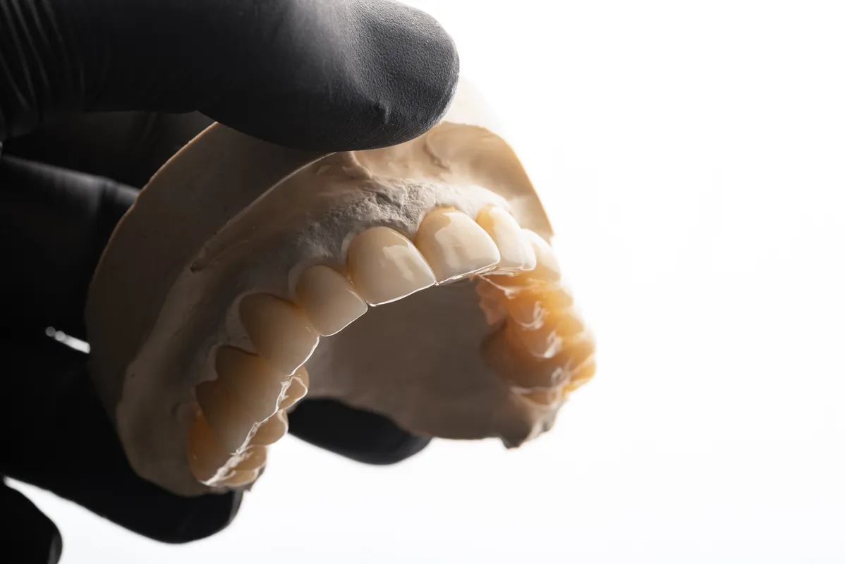 Lucrări Fixe - dentalbit dental bit tg mureș laborator tehnică dentară laborator tehnica dentara tg mures mures fogtechnikus marosvasarhely fogtechnia CAD/CAM exocad digital Laborator Tehnică Dentară Proiectare Digitală Dentară Lucrări Fixe Lucrări Fixe Pe Implant Lucrări Mobile Lucrări Mobilizabile tehnică dentară digitală