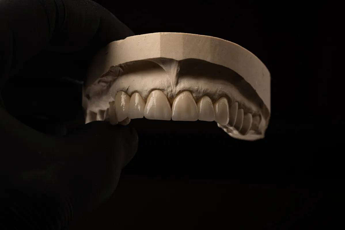 Lucrări Fixe - dentalbit dental bit tg mureș laborator tehnică dentară laborator tehnica dentara tg mures mures fogtechnikus marosvasarhely fogtechnia CAD/CAM exocad digital Laborator Tehnică Dentară Proiectare Digitală Dentară Lucrări Fixe Lucrări Fixe Pe Implant Lucrări Mobile Lucrări Mobilizabile tehnică dentară digitală